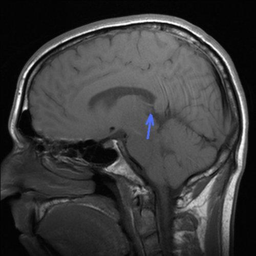 Melatonin is produced by the pineal gland, location indicated here.